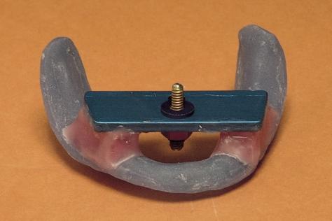 The lower plate lies over the most stable pivotal areas of the arch. The adjustable central-bearing screw is made to contact the upper plate at right angles and at the selected OVD.