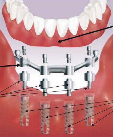 7 Connecting Bar This illustration shows an abutment supported overdenture that utilizes a connecting bar.