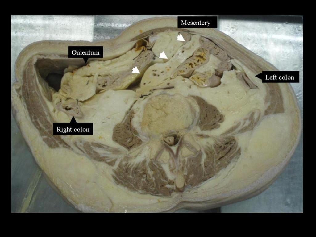 : Root of the small bowel mesentery: Peritoneal reflection that fixes the small bowel