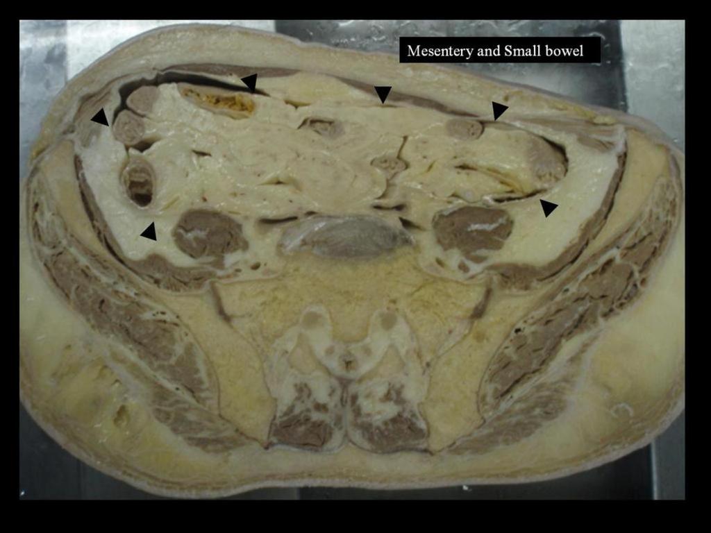 : Mesentery: It covers the small bowel