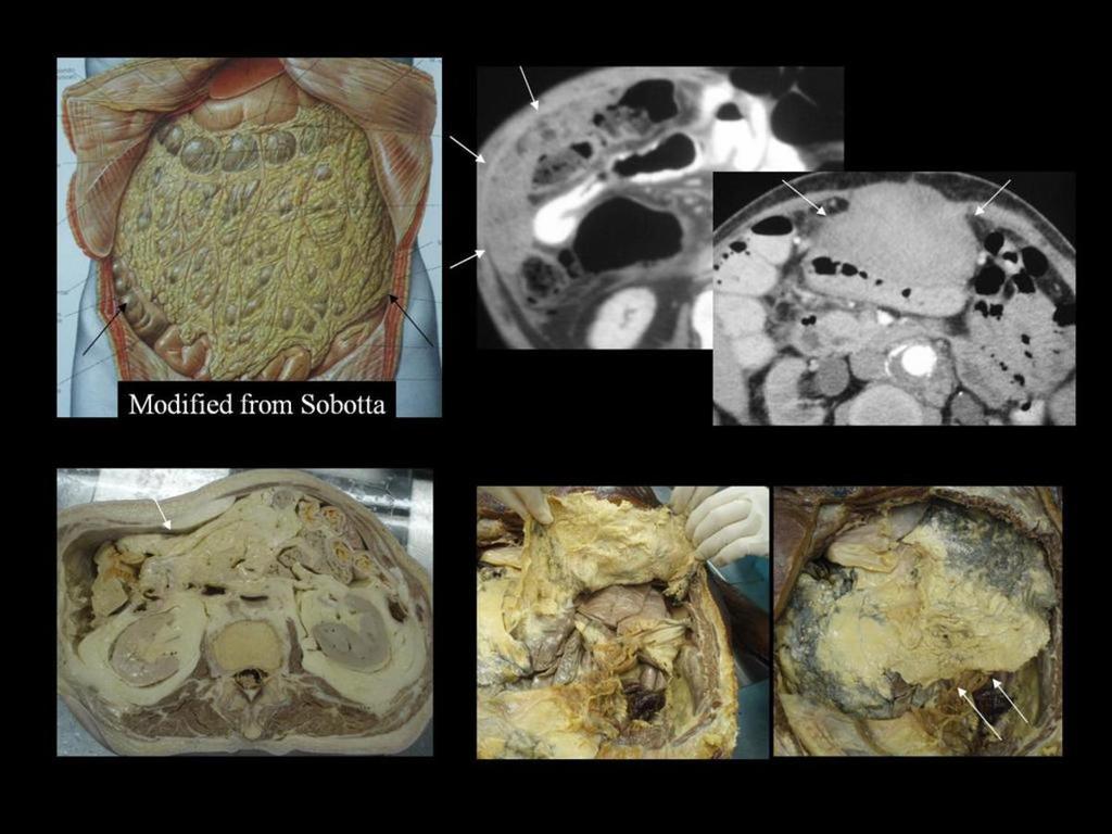 : Greater Omentum: The greater omentum descends from the gastric