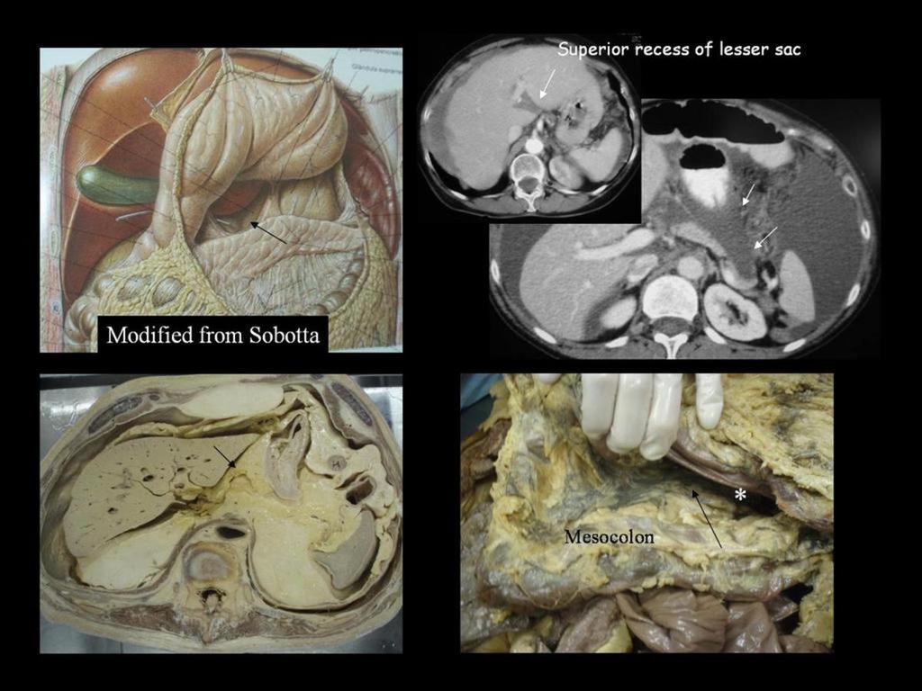 : Lesser sac: The lesser sac is a virtual compartment localized behinh to stomach and anterior to