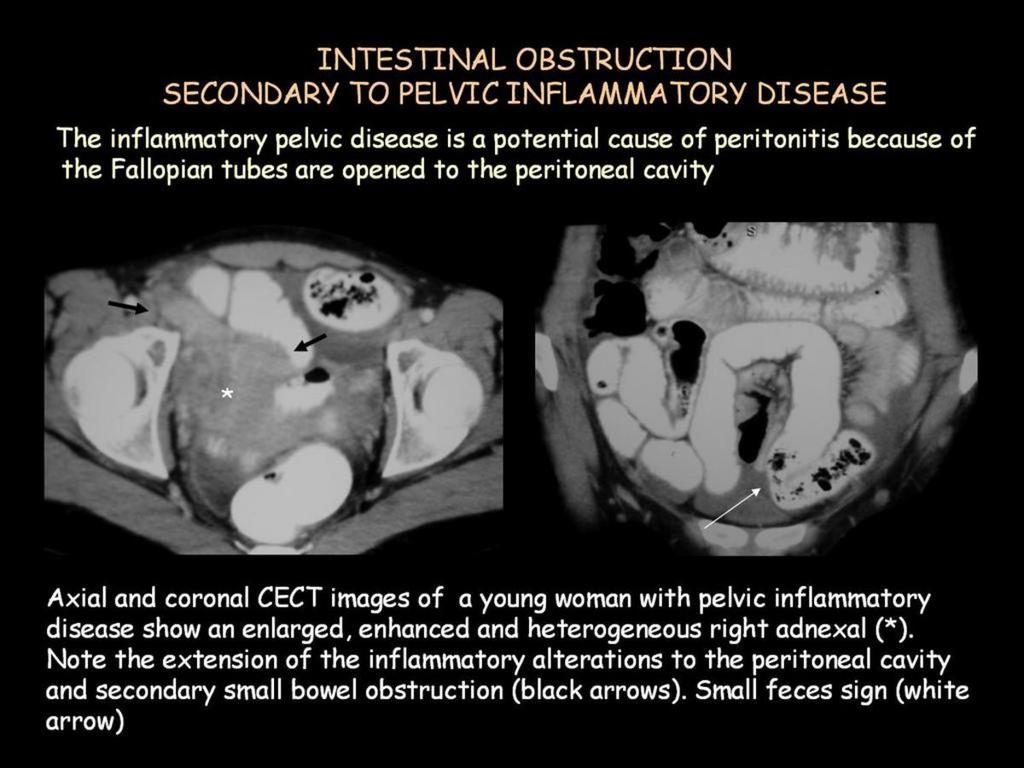 TUMOR AND TUMOR LIKE LESIONS: Secondary malignant peritoneal