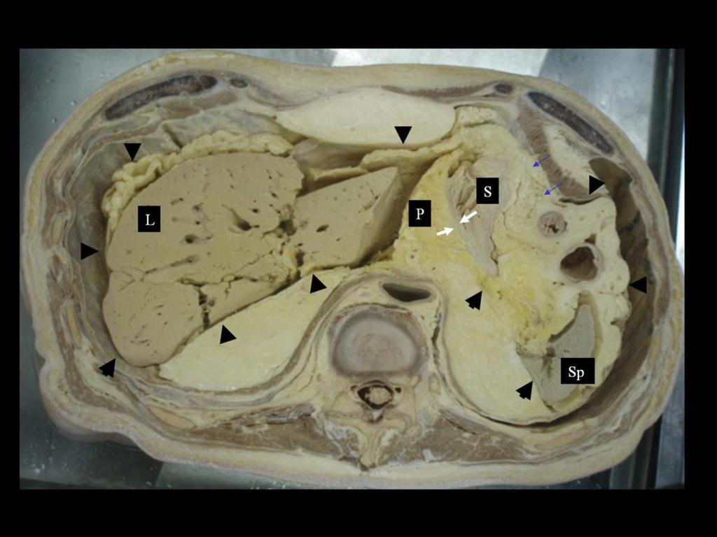 : Peritoneal cavity (black arrow heads), Lesser sac (white arrow heads), Greater