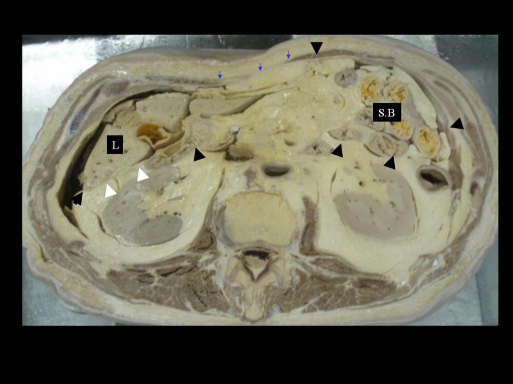 : Peritoneal cavity (black arrow heads), subhepatic space (white arrow