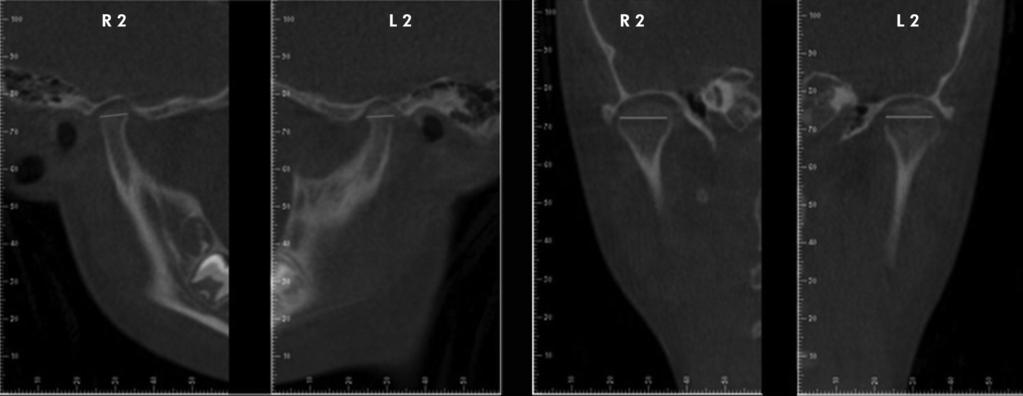 Evaluation of mandibular condyles in children with unilateral posterior crossbite Figure 2. Cuts Orientation Software Dolphin 3D (Dolphin Imaging/Patterson Dental, Chatsworth, USA). Figure 3.