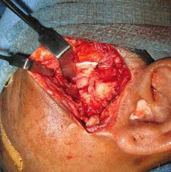 At the root of the zygomatic arch, the superficial layer of temporalis fascia was incised anterosuperiorly.
