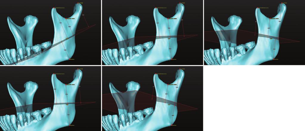 Novel three-dimensional position analysis of the mandibular foramen in patients with skeletal class III mandibular prognathism A B C D E Fig. 2.