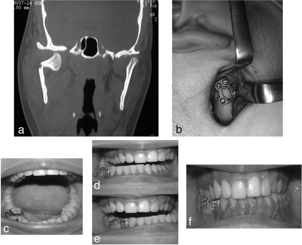 Spinzia et al. BMC Surgery 2014, 14:68 Page 7 of 10 adequate long-term results as demonstrated by the absence of complications such as plate fracture or screw loosening at the follow-up examination.