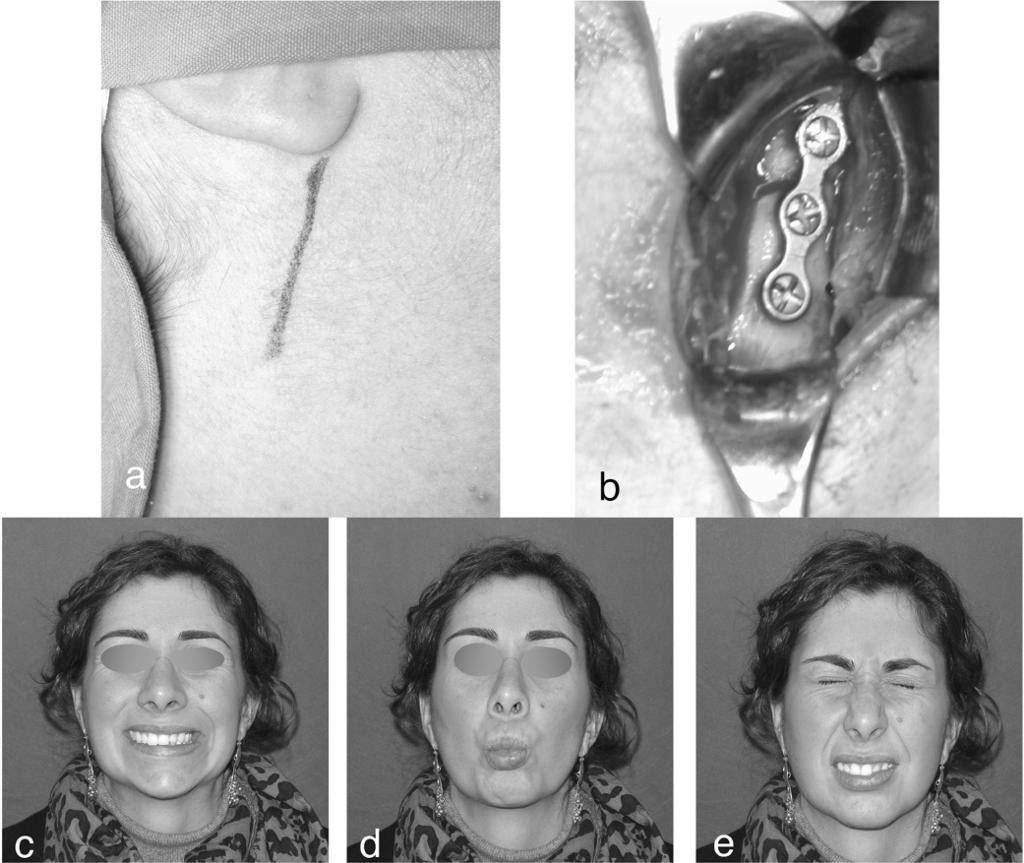 a) retromandibular approach; b) ORIF with a single plate; c,d,e) facial nerve