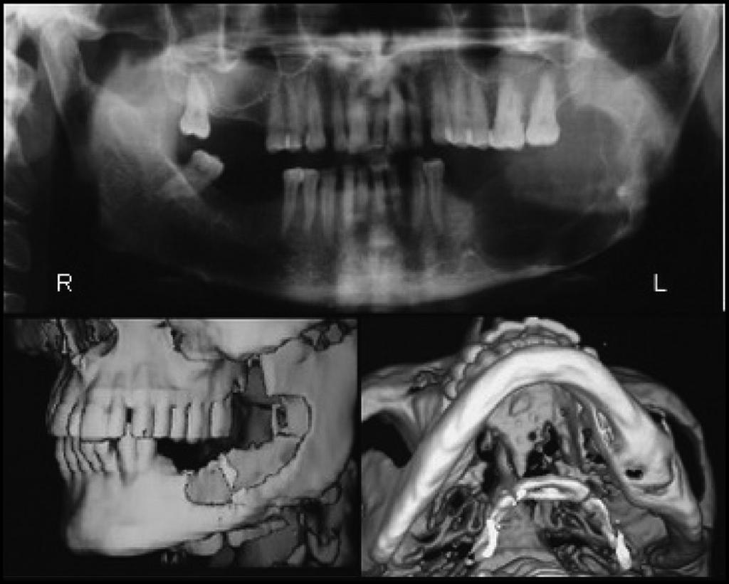 IMMEDIATE RECONSTRUCTION OF LARGE MANDIBULAR DEFECTS / Shirani et al Fig 1 Radiographic appearance of lesion (patient 6).