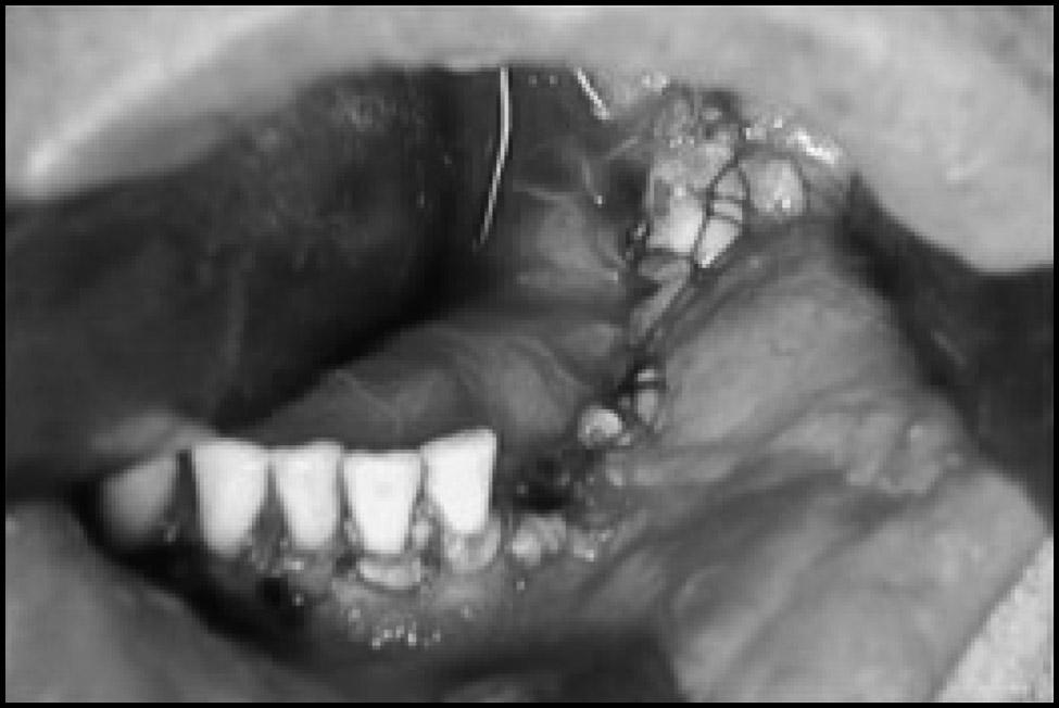 An intraoral mandibular reconstruction was done. Three year follow-up does not show any recurrence. Patient 3 A 24-year-old female was referred with a large swelling of the right side of mandible.