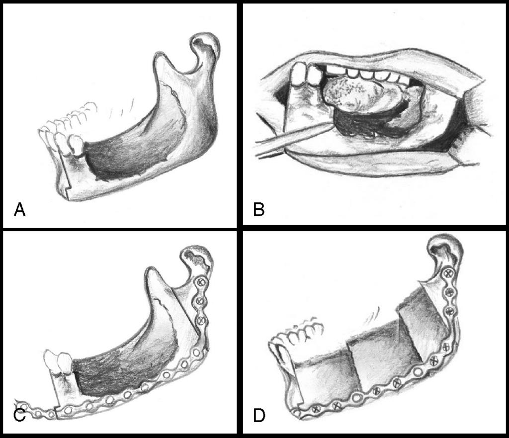 THE JOURNAL OF CRANIOFACIAL SURGERY / VOLUME 18, NUMBER 6 November 2007 Fig 9 (A) Anterior cut of lesion (note the step cut ), (B) Withdrawal of hemimandible with lesion intraorally, (C) Precise