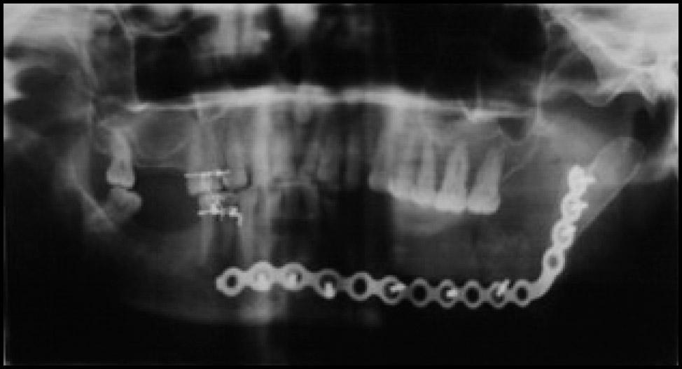 One year follow-up does not show any recurrence. Patient 5 A 23-year-old male was referred to our clinic because of swelling in posterior region of the left site of mandible.
