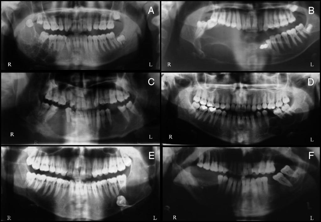 IMMEDIATE RECONSTRUCTION OF LARGE MANDIBULAR DEFECTS / Shirani et al Fig 12 Radiographic appearances of the lesions.