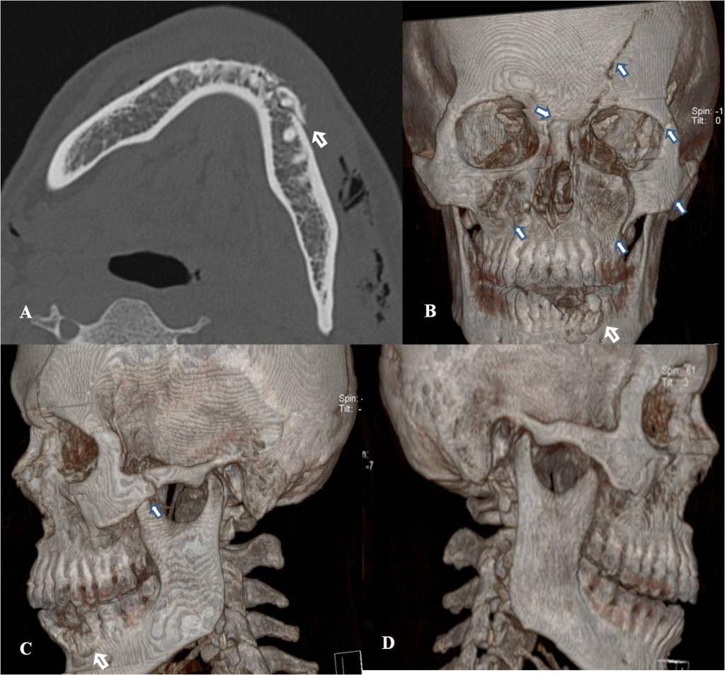 Figure 4: Left hemi mandible alveolar process unifocal fracture at symphysis and para symphysis region, left Le Fort I, II, III fracture, left tripod fracture, fracture of left frontal bone,