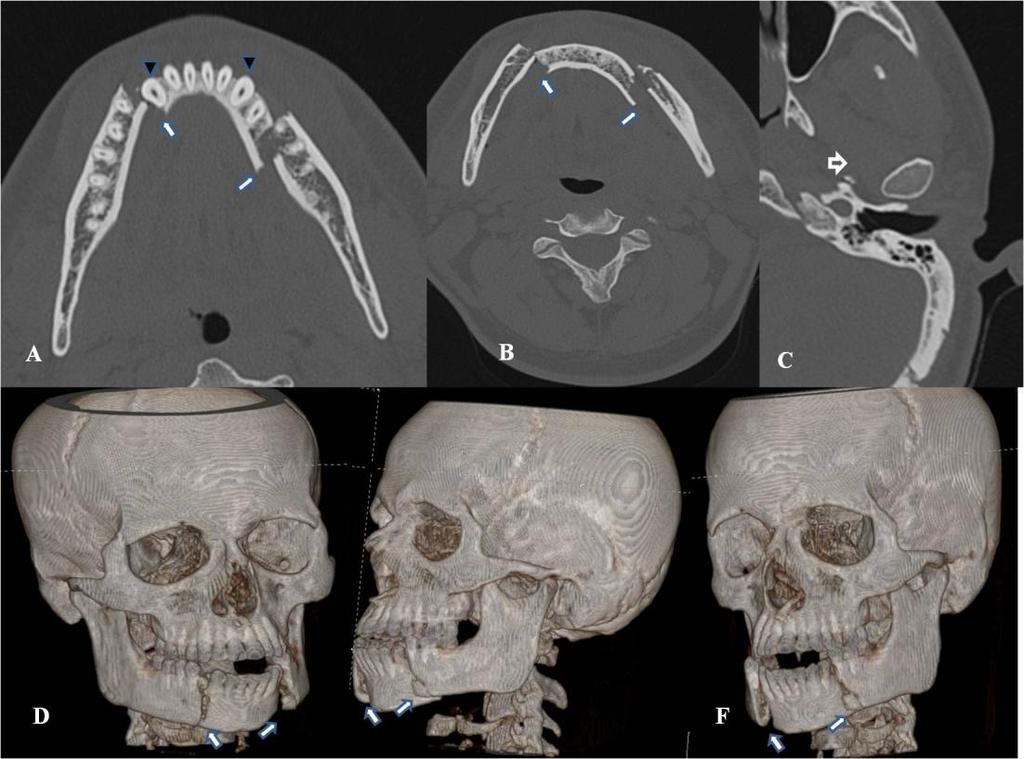 Figure 9: Displaced fracture involving bilateral body of mandible, mild left temporo mandibular joint dislocation A,B,C Axial section bone window, fracture line (Normal arrow) is seen lateral to
