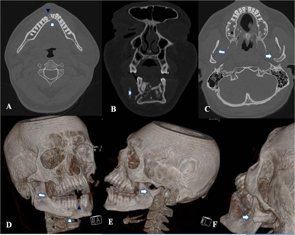 right hemi maxillary fracture, right pterygo maxillary disjunction (A,B,C outlined arrows).