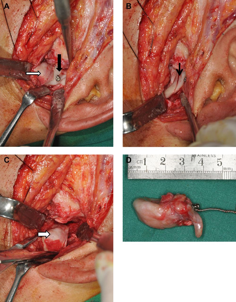 CHEN ET AL. FIGURE 4. Operative photographs. (A) The condyle (white arrow) was pushed infra-anteriorly to expose the mass (thick dark arrow).