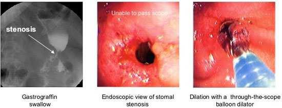 Stricture EGD