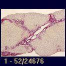 IF-associated liver