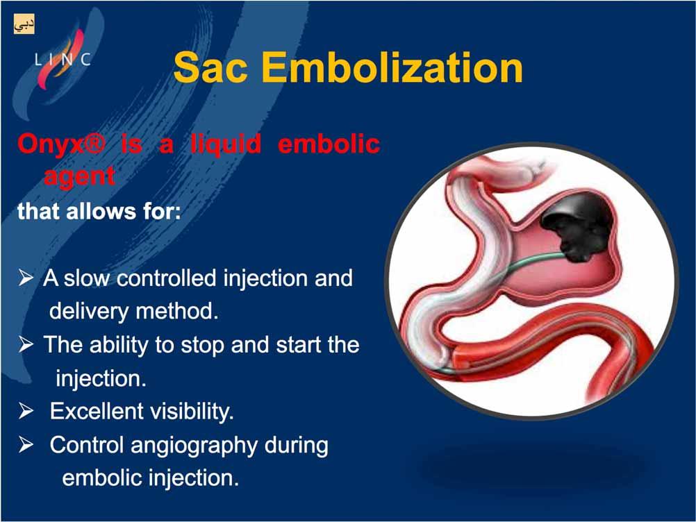 Sac Embolization Onyx is a liquid embolic agent that allows for: A slow controlled injection and delivery method.