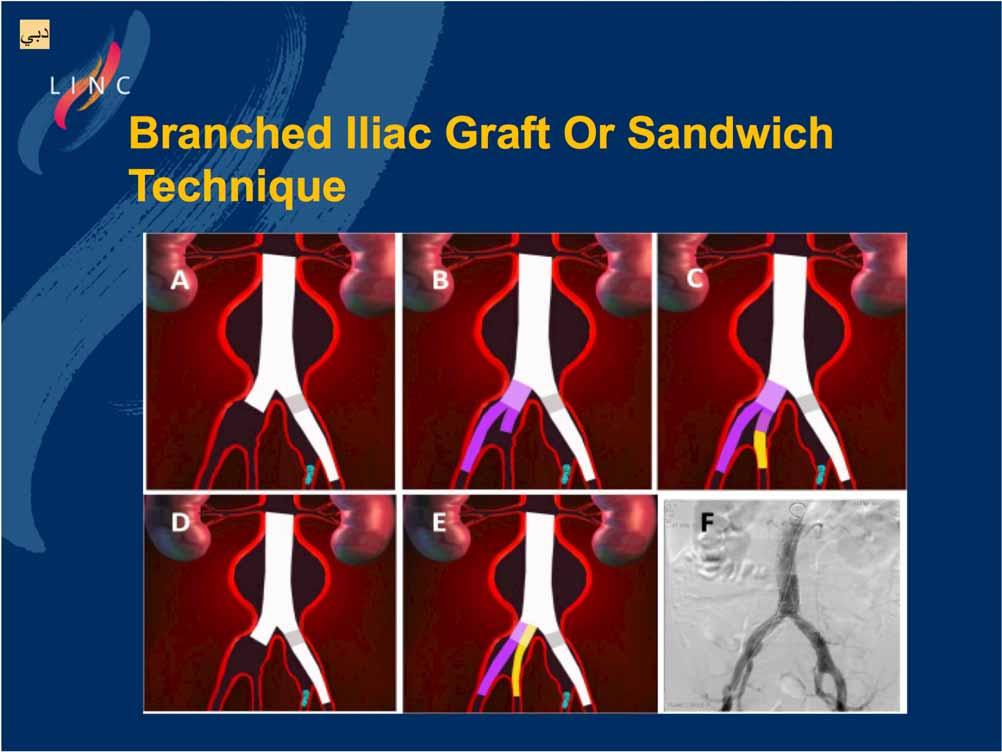 Branched Iliac Graft