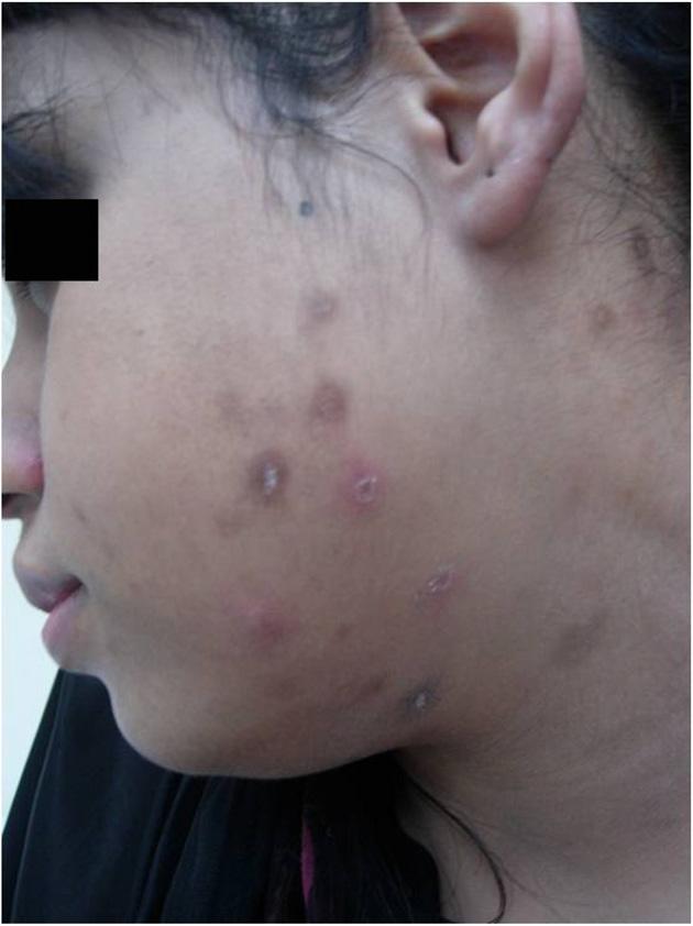 The majority of skin lesions of KD show the characteristic histological changes that parallel those of the lymph nodes and show a lymphohistiocytic infiltrate, dermal edema, abundant nuclear debris