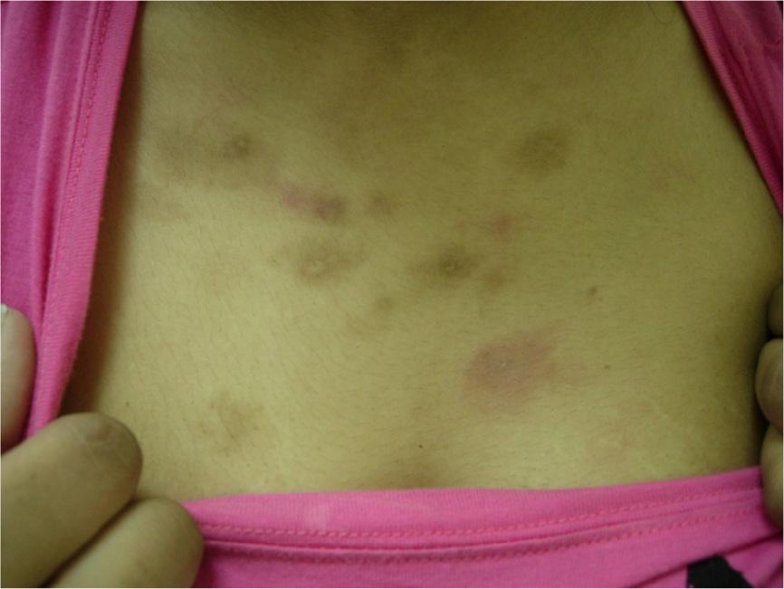 Kikuchi s disease (necrotizing lymphadenitis) presenting as acneiform eruption 69 Figure 3 Edematous plaques with erythematous macules and papules over the chest with post-inflammatory pigmentation.
