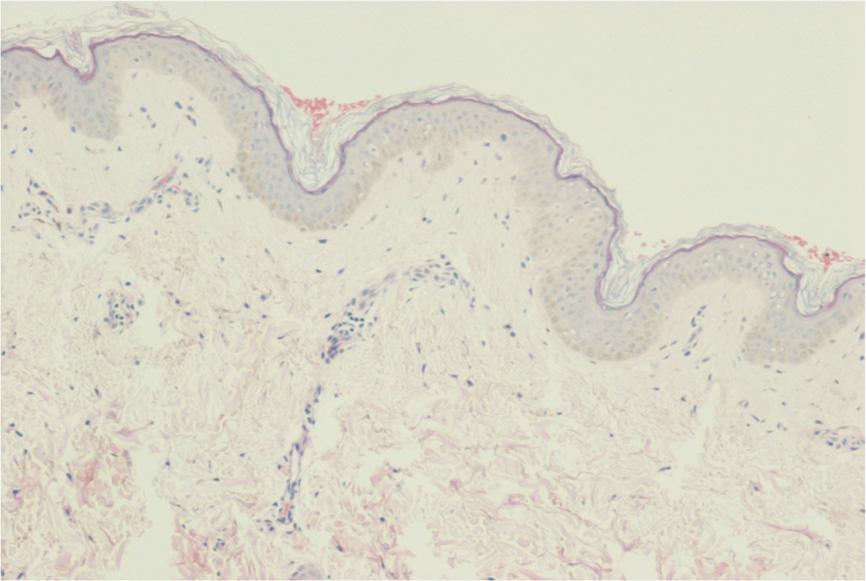 Figure 4 Focal hyperkeratosis, spongiosis and a mononuclear inflammatory infiltrate around superficial and deep dermal vessels (hematoxylin eosin stain; original magnification 100).
