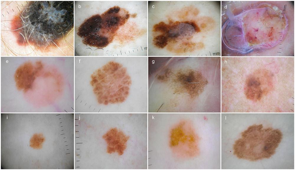 Figure 2. Dermoscopic images. MMC (A-D): (A) superficial extensive melanoma, Breslow 2.5 mm, Clark IV; (B) superficial extensive melanoma, Breslow 0.