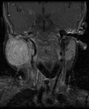 MRI: around mandible