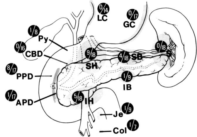 882 CANCER March 1978 Vol. 41 FIG. 1. Distribution of lymph nodes in 18 regional pancreatectomy resection specimens.