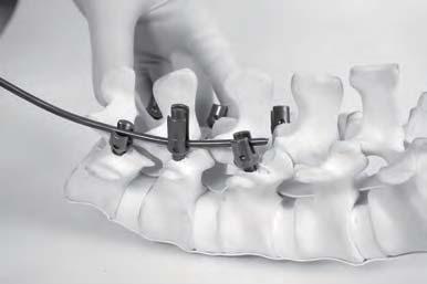The rod does not have to be precisely bent for attachment to the pedicle screws, especially for a single-level fusion.