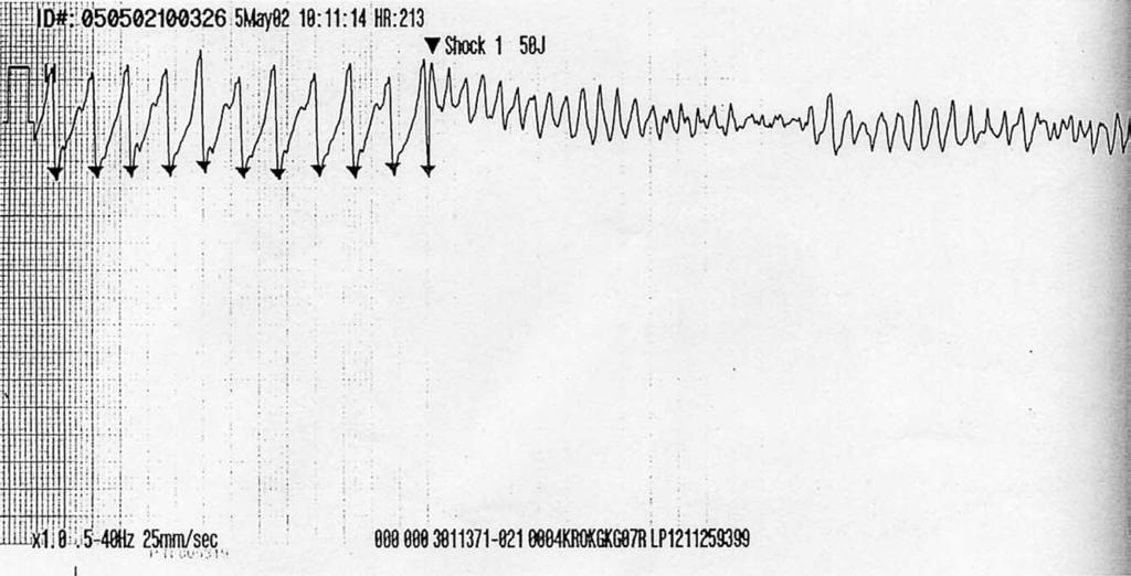 Figure 2. A patient with sustained monomorphic ventricular tachycardia is externally cardioverted with a synchronized, low-energy (50 J) monophasic shock.