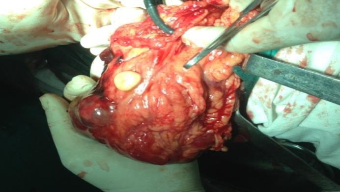 Figure 7: Intraoperative photograph of cystic areas.