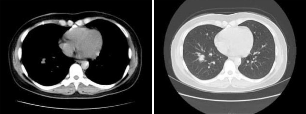 Intern Med 54: 2051-2055, 2015 Figure 1. Initial computed tomography of the chest.