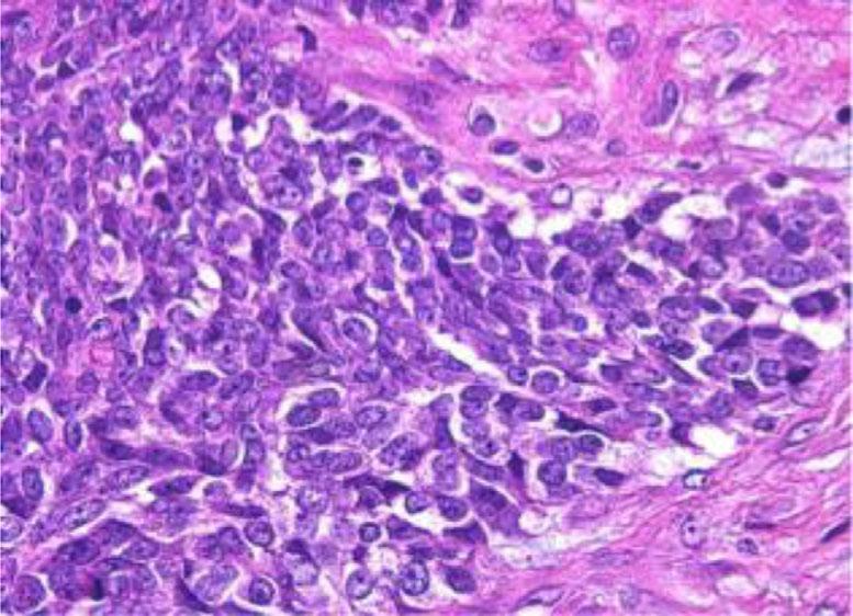 The immunohistochemical staining was positive for CD99 (B) and vimentin (C) and focal for Bcl-2 (D) and cytokeratins (E).
