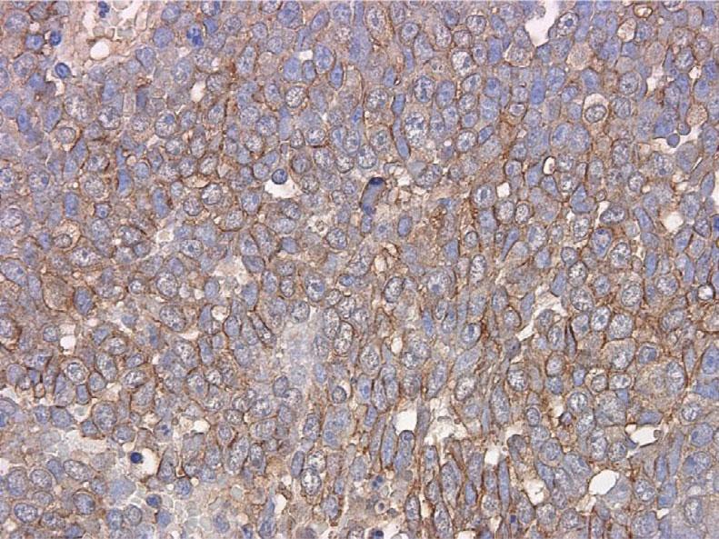 Immunohistochemical analyses revealed positive staining for CD99 and vimentin and focal staining for B-cell lymphoma 2 (Bcl-2) and cytokeratins (Fig. 3).