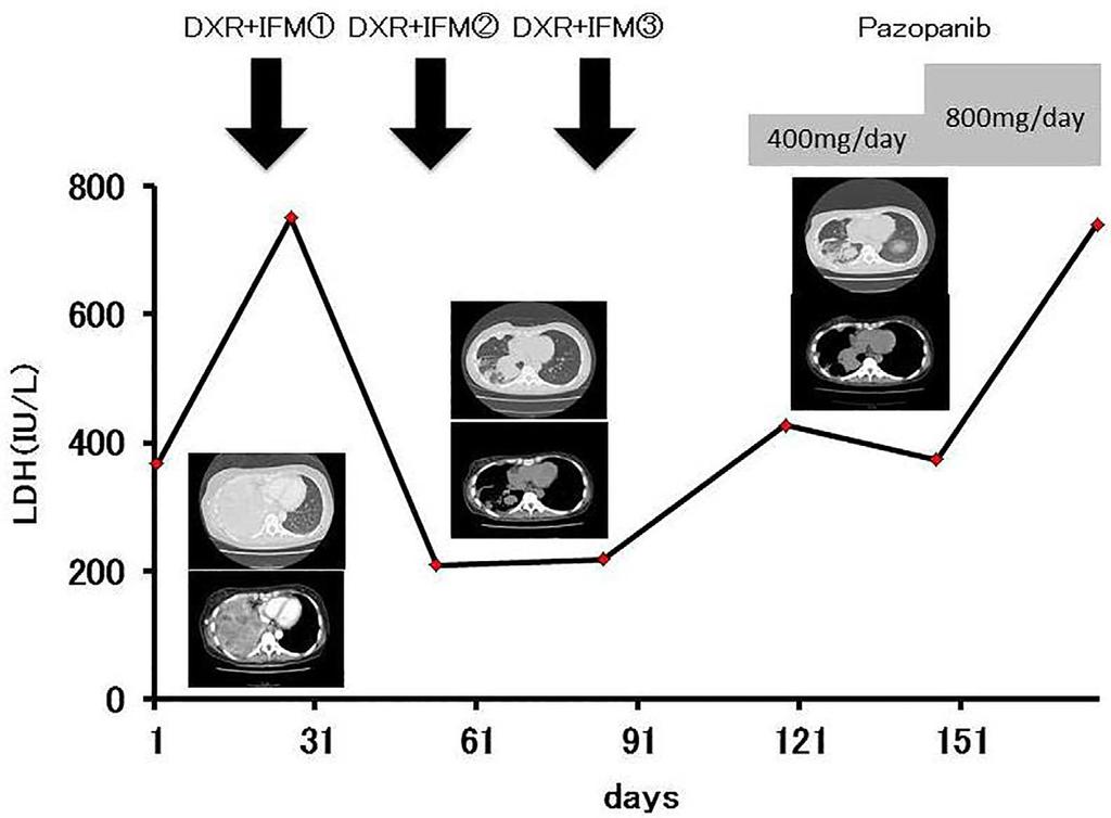 Figure 4. Clinical course. First-line chemotherapy [doxorubicin (DXR) plus ifosfamide (IFM)] resulted in progressive disease after a partial response.
