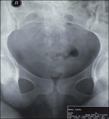 Figure 3: Case Report A twenty five year old female, primparous, underwent Caesarean Section for failure of progress during the second stage of labour.