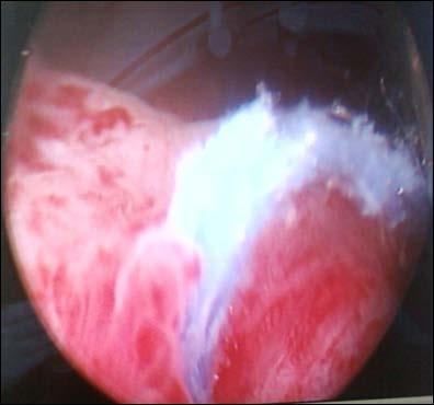 At cystoscopy there was severe edema at the left ureteric orifice and during