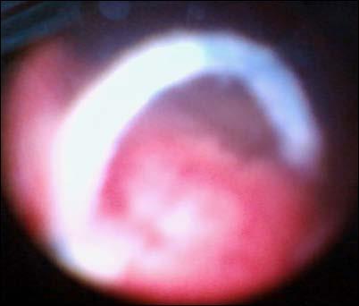 Figure 10: Figure 13: Figure 11: Cysoscopy at that time also showed normal