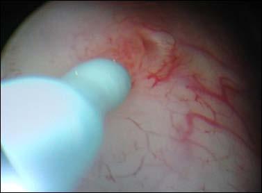 ureteric stent.