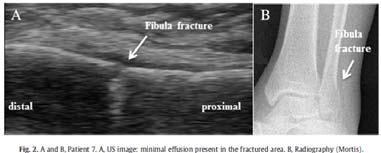 009) Fracture was detected in 21 patients (16%) by US evaluation Radiographic examination: criterion