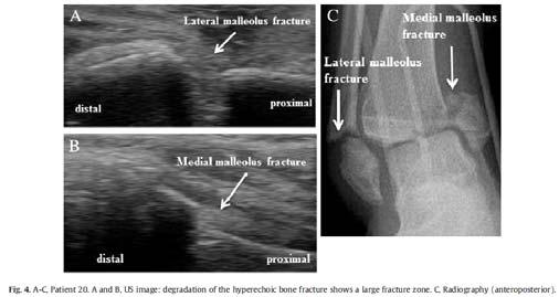 Canagasabey et al US sensitivity and specificity in diagnosing fractures were 90.