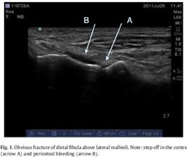 Methods Patients were admitted Normal routine OAR examination and the US examination of the ankle and lower leg