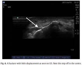 Radiographs identified 23 significant fractures, all of them were interpreted as fracture or uncertain/other finding by the US triage doctor There were 13 uncertain/other findings and 24 fractures on
