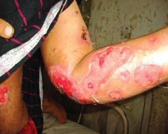 Abdul Wahab et, al. tions of the disease. Complications of the pemphigus were due to the steroid therapy and were seen in 16% cases.