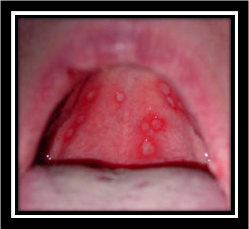 Stomatitis http://www.entusa.com/oral_photographs/20080102-stomatitis-palate_small.jpg Oral inflammation and ulcers, known as stomatitis, may be mild and localized or severe and widespread.